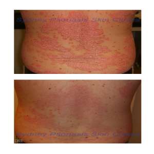 Chronic Plaque Psoriasis (Psoriasis Vulgaris)