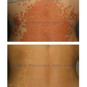 Chronic Plaque Psoriasis (Psoriasis Vulgaris)