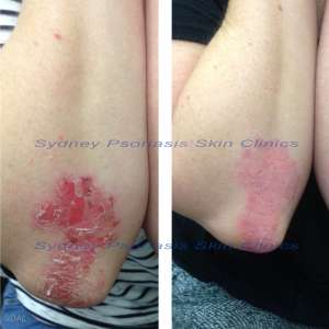 Chronic Plaque Psoriasis (Psoriasis Vulgaris)