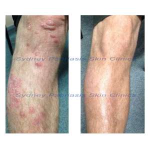 Chronic Plaque Psoriasis (Psoriasis Vulgaris)